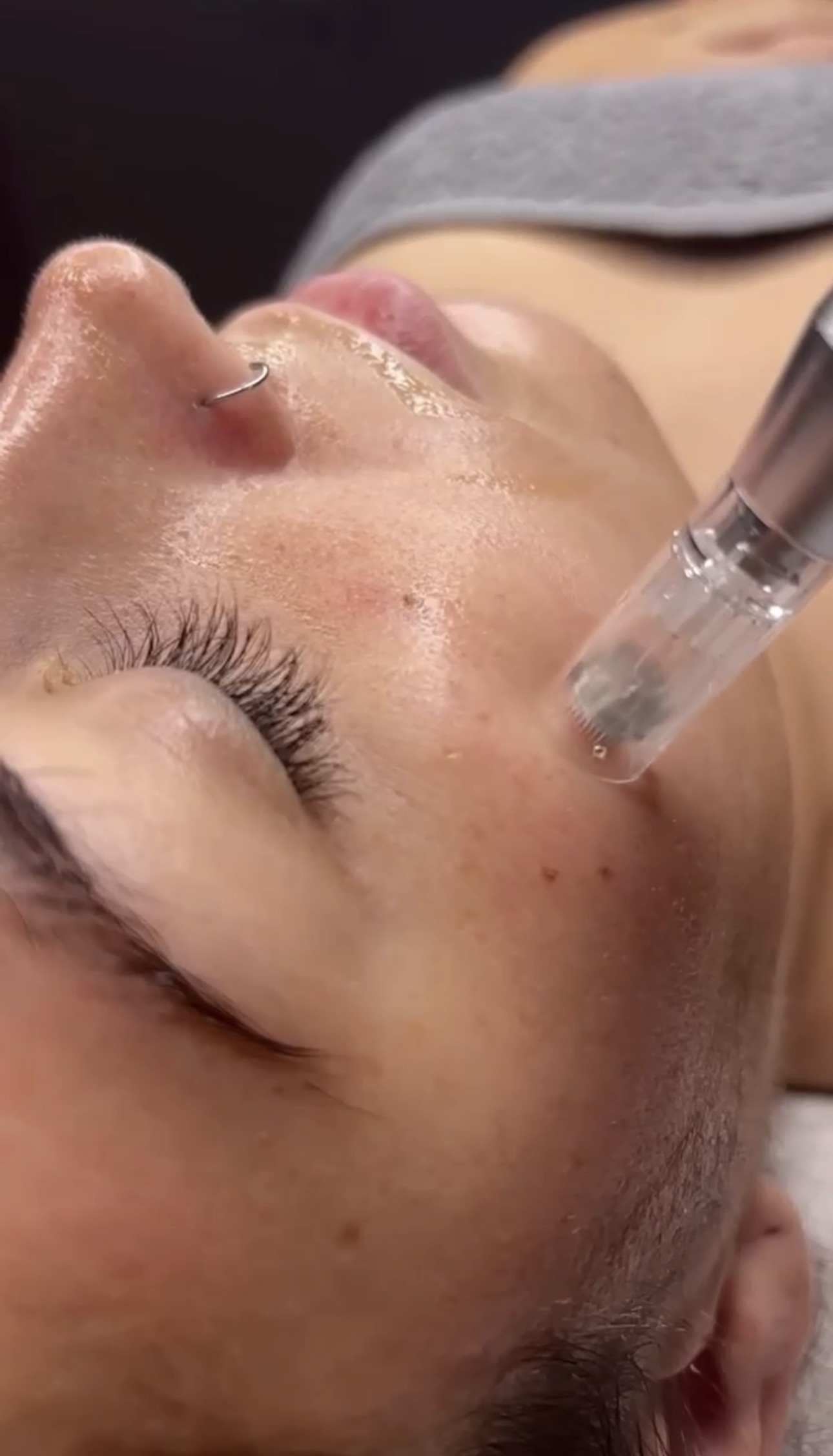 Microneedling